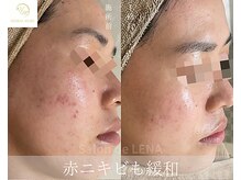 サロンドレナ 名駅店/ハーブピーリング サロンドレナ