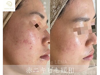 サロンドレナ 名駅店/ハーブピーリング サロンドレナ