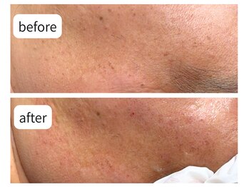 カシェット(Cachette)/50代男性COCOREGEN シミケア60分