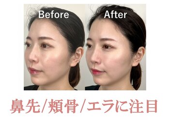 ラプリシュシュ 岡山店(Raplit)/ 隆鼻+輪郭矯正40分1回