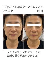 フラワー(FLOWER)/Lit初回の肌変化　プラズマ