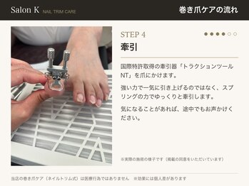 サロン ケー(Salon K)/巻き爪ケアの流れ4　牽引