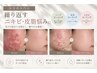 【繰り返すニキビ・皮脂改善コース】基礎の毛穴洗浄+ニキビ専用ピーリング