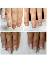 エヌスタイル(N-STYLE)/深爪改善ケア