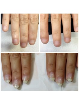 エヌスタイル(N-STYLE)/深爪改善ケア