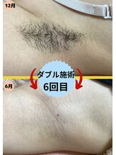 ディスイズミー シュガーリング(This is me Sugaring)/【ダブル】剃刀・ピンセット不要
