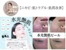 水光ピーリング★即プルプル美肌に！ニキビ◎ダウンタイム無し！