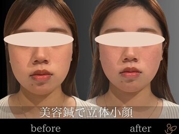 チョコバリ 新宿店(chocobari)/小顔×リフトアップ(美容鍼)20代