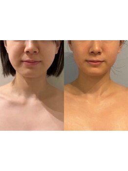 小顔になりたい