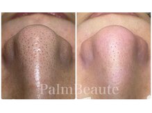 パームボーテ(Palm Beaute)/一つ一つ大掃除！毛穴収縮力UP!