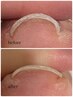 【全員】巻き爪補正 &nbsp;