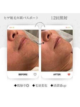 エクラ アン(eclat.un)/50代男性：ヒゲ脱毛