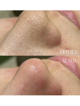 #美容革命ラボ 大阪南堀江店/毛穴洗浄ハイドラフェイシャル