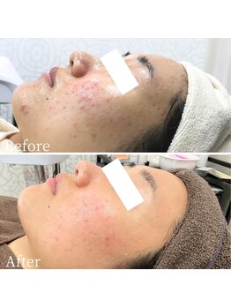 エステ ニキビケア研究所 川崎店/跡やシミも改善!