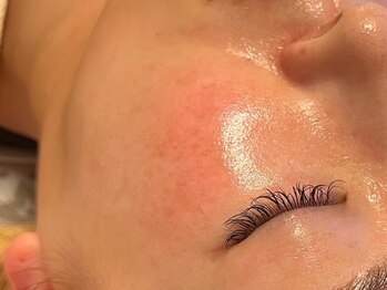 アメリ―ボーテ 恵比寿(Amelie beaute)の写真/【プラズマでシミケア/肝○ケア】世界一のプラズマで毛穴レス/シミケア/ニキビケア/美白美肌ケア