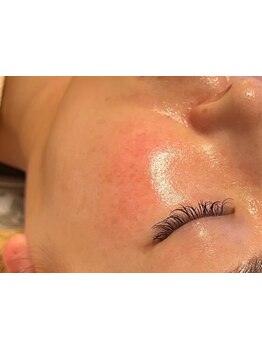 シミしわ改善！予防ケア