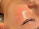 アメリ―ボーテ 恵比寿(Amelie beaute)の写真/【プラズマでシミケア/肝○ケア】世界一のプラズマで毛穴レス/シミケア/ニキビケア/美白美肌ケア