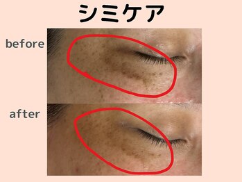 ウィズマツオカ 菊池本店/シミケアデトックス