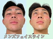 ナチュラルパーフェクトフェイス 新宿/フェイスラインの歪み/新宿小顔