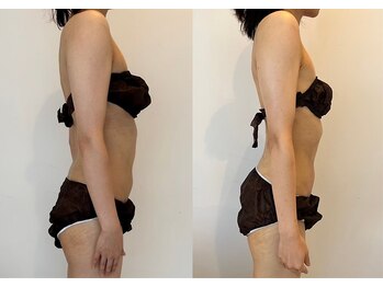 アンフィルミエール 若葉本店(infirmiere)の写真/全身の脂肪を分解★運動や食事制限、痛みが苦手な方にもおすすめ！お気軽にご相談ください◎