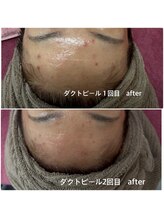 リエル(Liel)/ダクトピール１回目 ２回目after