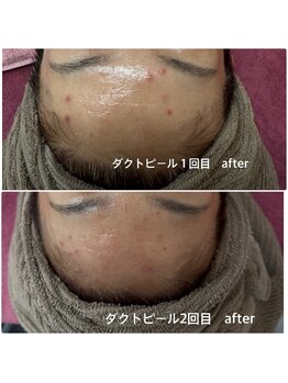 リエル(Liel)/ダクトピール１回目 ２回目after