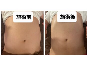 リベル(Liber)/痩身マシンエクシリス【腹部前】