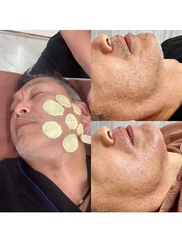 ハニーアイズ(Honey Eyes)の写真/痛みの少ない最新脱毛機器を使用！産毛にもしっかりアプローチ！脱カミソリで朝の準備も時短に◎