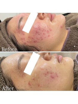 エステ ニキビケア研究所 川崎店/肌質改善フェイシャルエステ