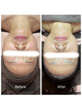 ヒール(heal)/60代毛穴、もたつき、乾燥