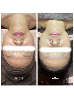 ヒール(heal)/60代毛穴、もたつき、乾燥