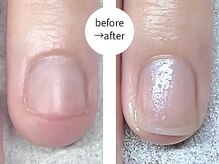 エマ(EMA)/深爪でずっと伸ばせなかったお爪