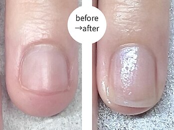エマ(EMA)/深爪でずっと伸ばせなかったお爪