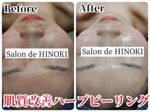 サロン ド ヒノキ(Salon de HINOKI)/肌質改善ハーブピーリング