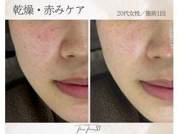 スリースリー(THREE THREE)/乾燥・赤みケア