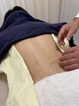 番町もくの木鍼灸院/鍼　腰部施術