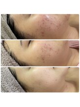 エムリシェ(M.riche)/ハーブピーリング