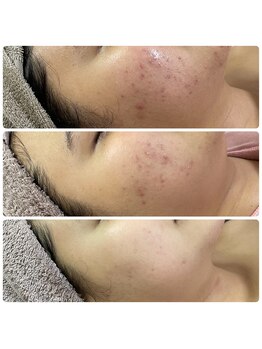 エムリシェ(M.riche)/ハーブピーリング