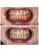 ボディケアアップ(BODY CARE UP↑)/1回目→4回目の変化