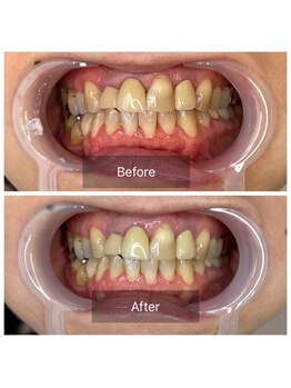 ボディケアアップ(BODY CARE UP↑)/1回目→4回目の変化