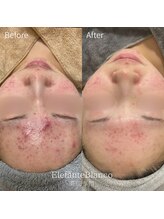 エレファンテブランコ(Elefante Blanco)/☆ニキビ＆脂性肌