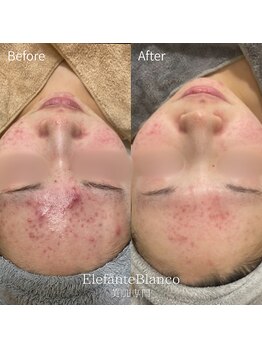 エレファンテブランコ(Elefante Blanco)/☆ニキビ＆脂性肌