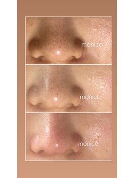 モニコ(monico)の写真/季節ごとの肌悩みや気になる毛穴の黒ずみ対策に◎なめらかで透明感のあるクリアな印象を手人れる！
