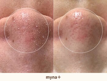 マイナプラ 表参道(myna+)の写真/毛穴悩みに大人気★【角栓・毛穴詰まり徹底ケア】プレミアム3STEPハイドラ毛穴洗浄 ¥10800-