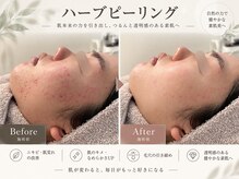 カエラ(KAELA)の雰囲気(毛穴詰まり/白ニキビ/ざらつきにはこちら!短時間お手入れ可能☆)