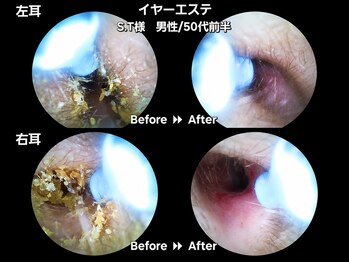 ツバキ 岐阜店(TSUBAKI)/【2】イヤーエステbefore→After