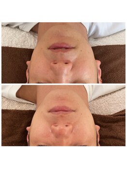 ノフ 恵比寿(noff)/効果)美容鍼 bf→af