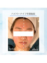ルミナ ビューティーアンドリラックス(LUMINA Beauty&Relax)/ハイパーナイフ半顔での変化☆