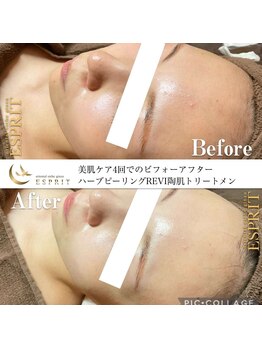 エスプリ 銀座店/ハーブピーリング銀座