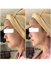 スペチアーレ 夙川/横顔も更に美しく美顔革命